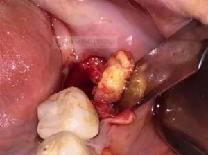 antes de una extracción traumática y eliminación de infecciones