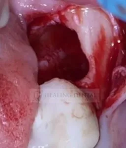 antes de una extracción traumática y eliminación de infecciones